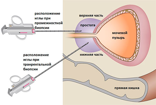 биопсия при раке простаты