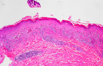 Гистологические типы рака желудка thumbnail