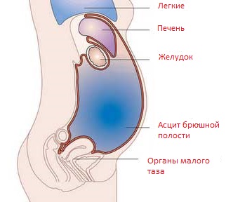 асцит при раке органов