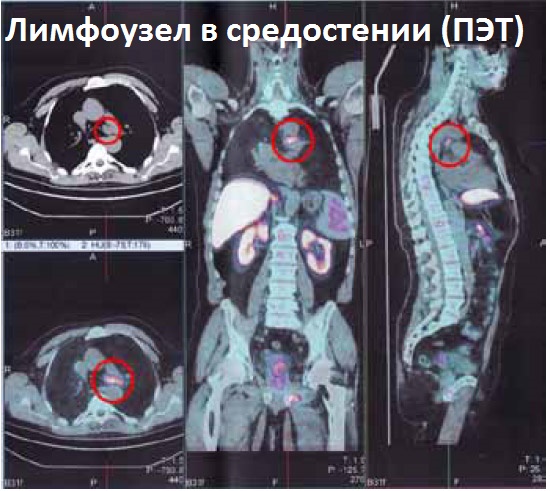 Где Находятся Лимфатические Узлы На Шее Фото