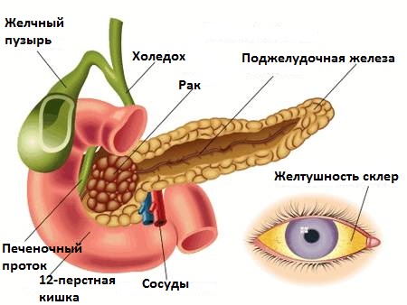 механическая желтуха и ее причины