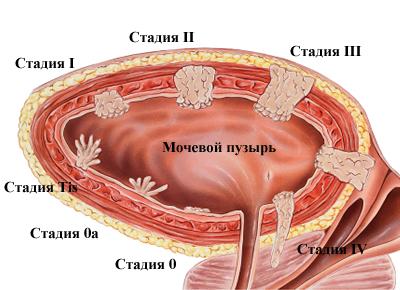 Реферат: Рецидив рака мочевого пузыря T2N0M0