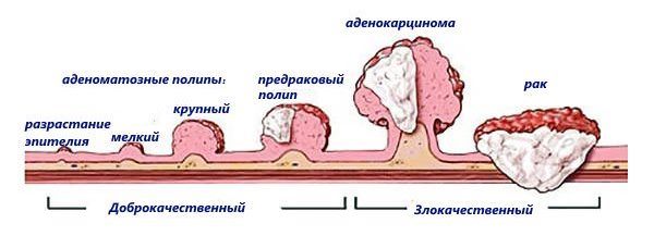 стадии рака прямой кишки 