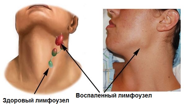  метастазов в лимфатических узлах