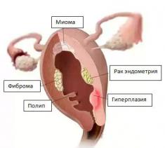 рак матки