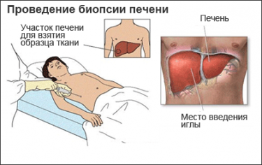 биопсия печени
