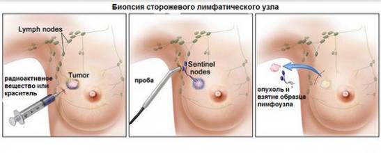 биопсия лимфоузла
