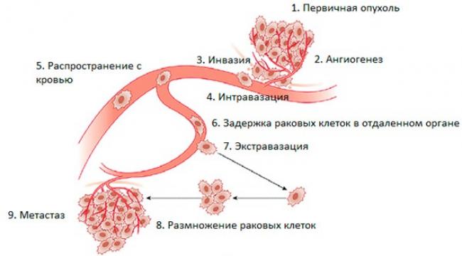 образование метастазов в лимфоузлах