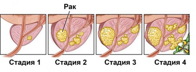 стадии рака простаты