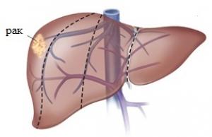 Первая стадия рака печени