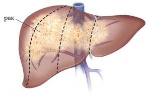 четвертая стадия рака печени