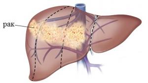 третья стадия рака печени