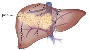 Рак печени 3 стадии. Гепатоцеллюлярная карцинома печени. Карцинома печени стадии. Карцинома печени признаки. Онкология печени симптомы.