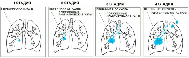стадии рака легкого