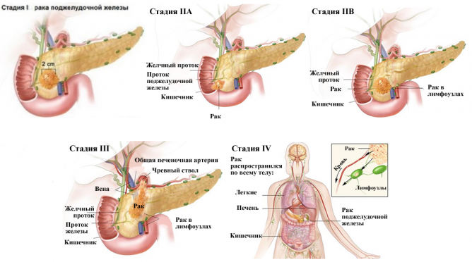 Стадии рака поджелудочной железы