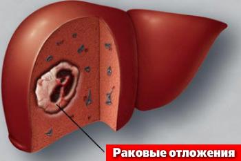 Метастазы в печени
