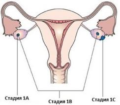 Рак Яичников Фото