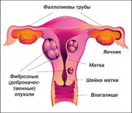 фиброма матки