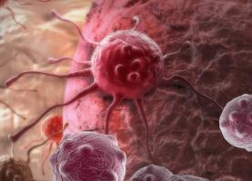 Метастазы рака мочевого пузыря