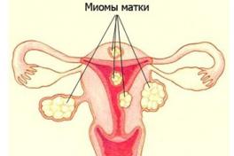 миома матки