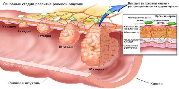стадии рака кишечника