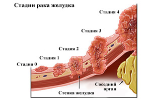 рак желудка стадии